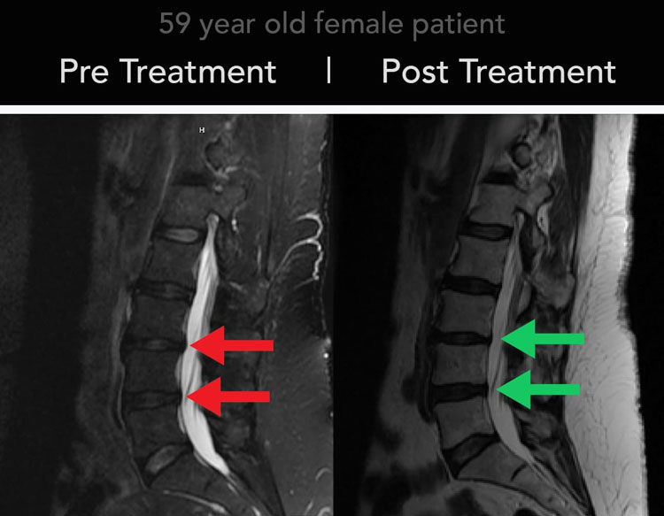 Chiropractic Plymouth Meeting PA Spinal Decompression Before and After