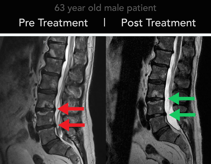 Chiropractic Plymouth Meeting PA Spinal Decompression Before and After