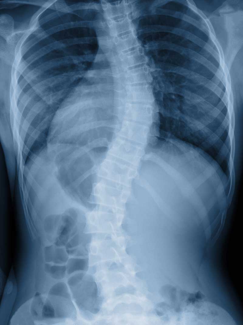 Scoliosis  Plymouth Meeting, PA